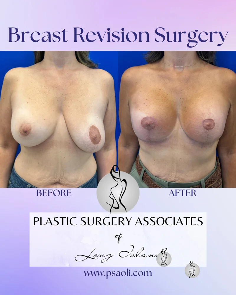 Breast Revision Surgery – 1