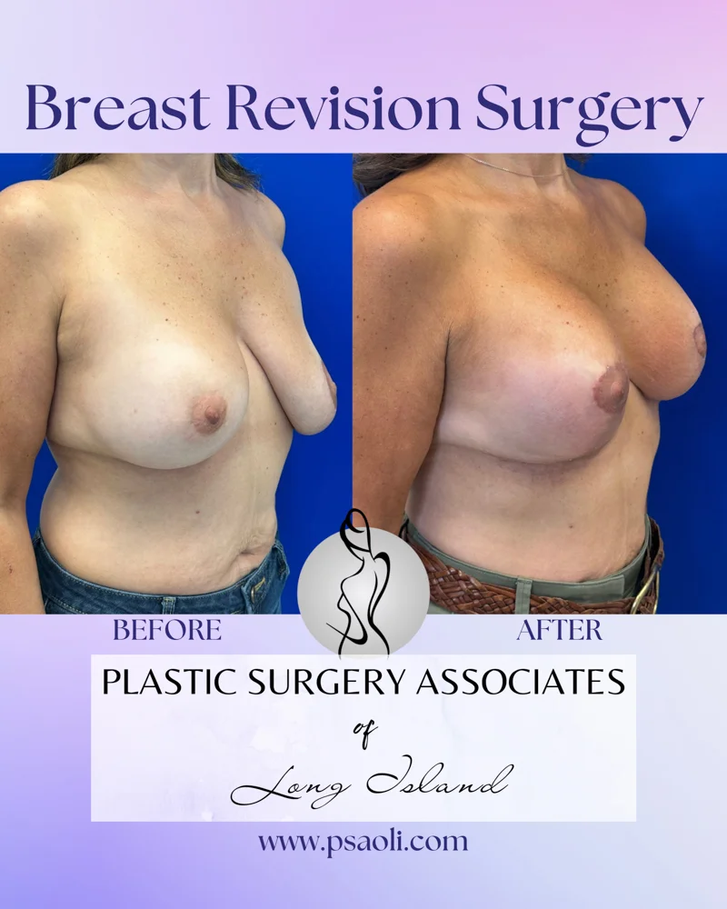 Breast Revision Surgery – 2
