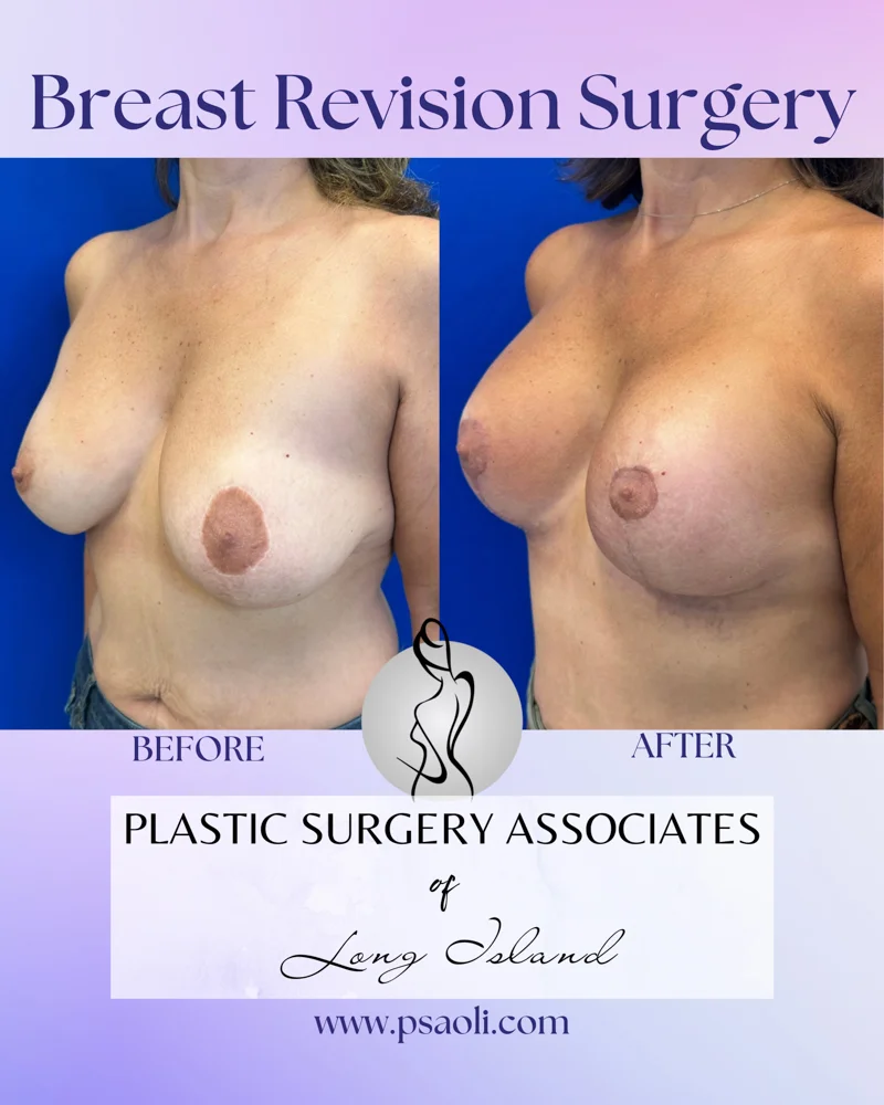 Breast Revision Surgery – 3