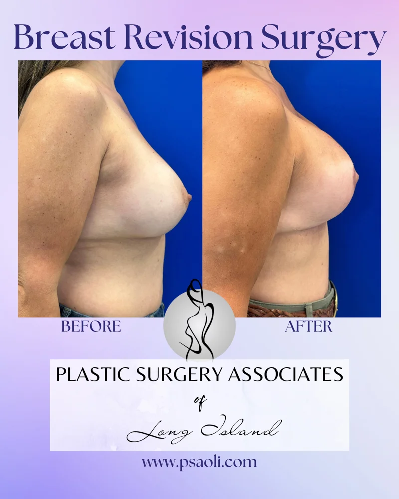 Breast Revision Surgery – 5