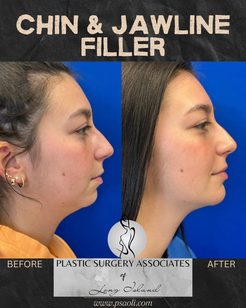 Chin & Jawline Filler – 1