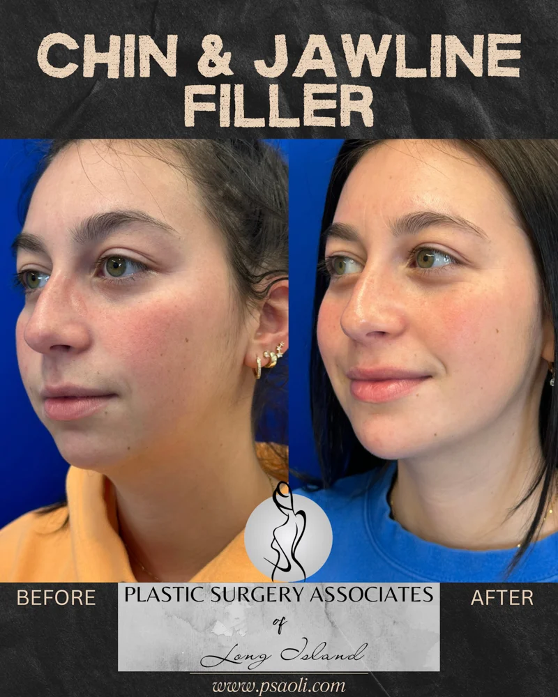 Chin & Jawline Filler – 2