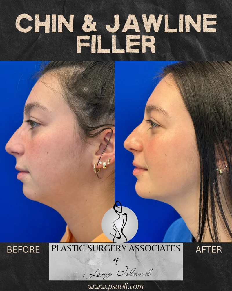 Chin & Jawline Filler – 3