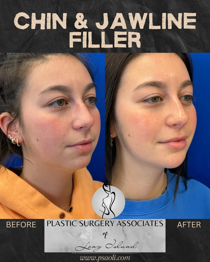 Chin & Jawline Filler – 4