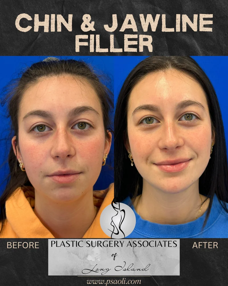 Chin & Jawline Filler – 5