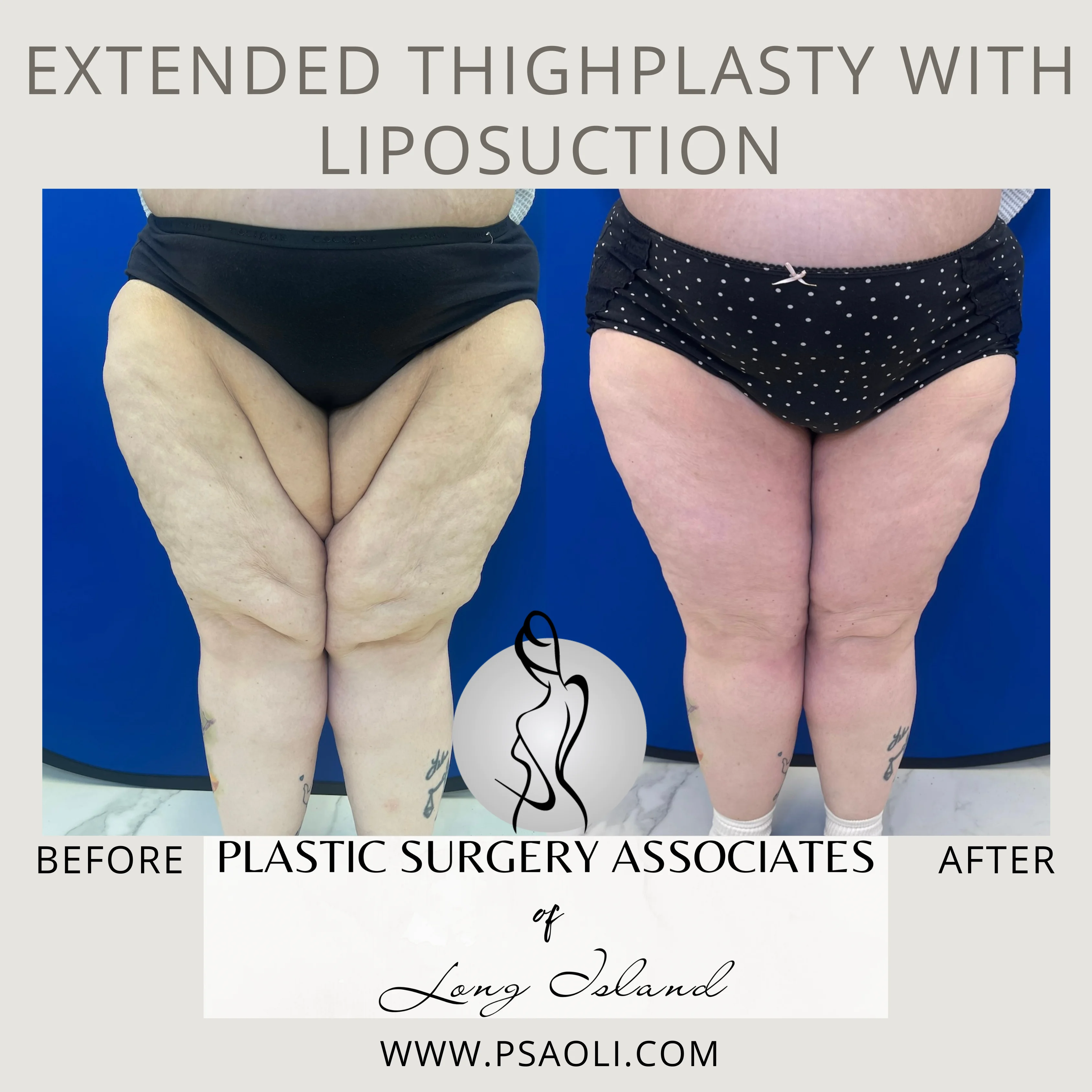 Extended ThighPlasty with Liposuction – 1