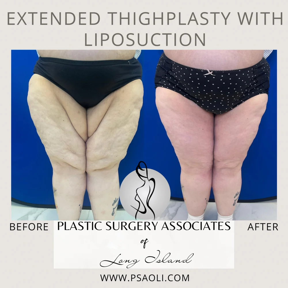 Extended ThighPlasty with Liposuction – 1