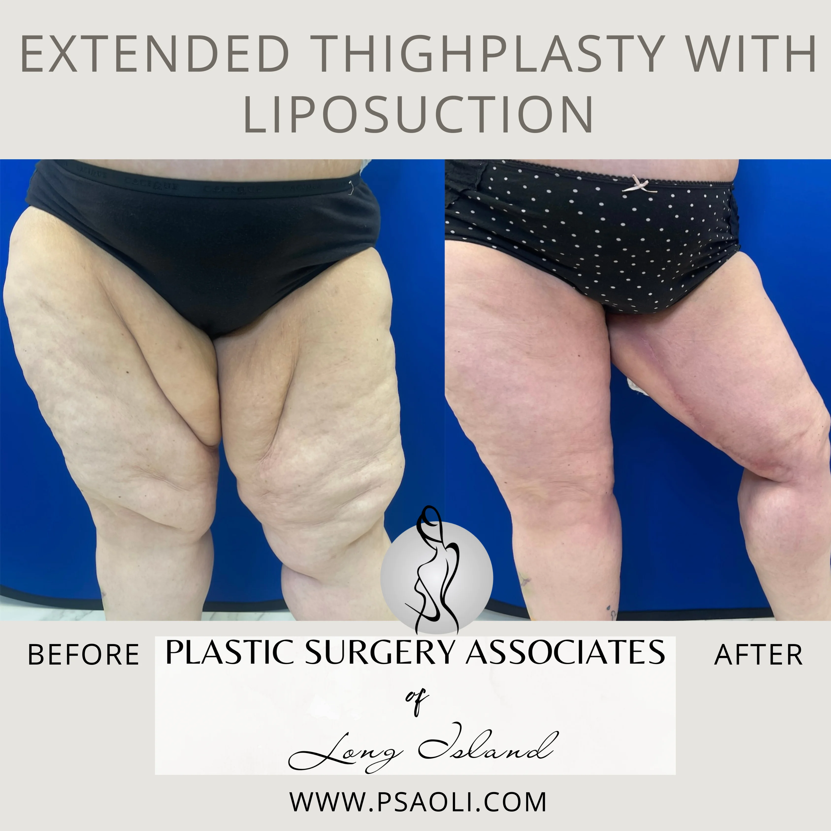 Extended ThighPlasty with Liposuction – 2