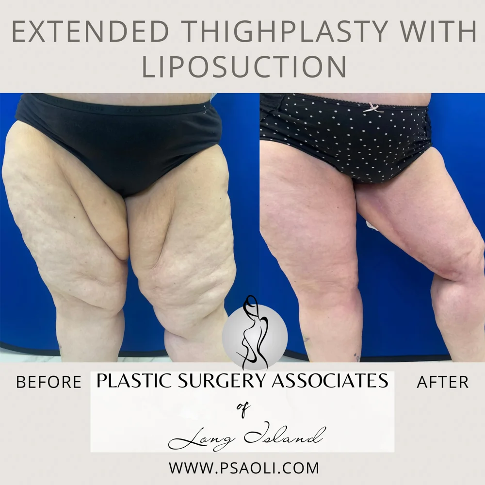 Extended ThighPlasty with Liposuction – 2