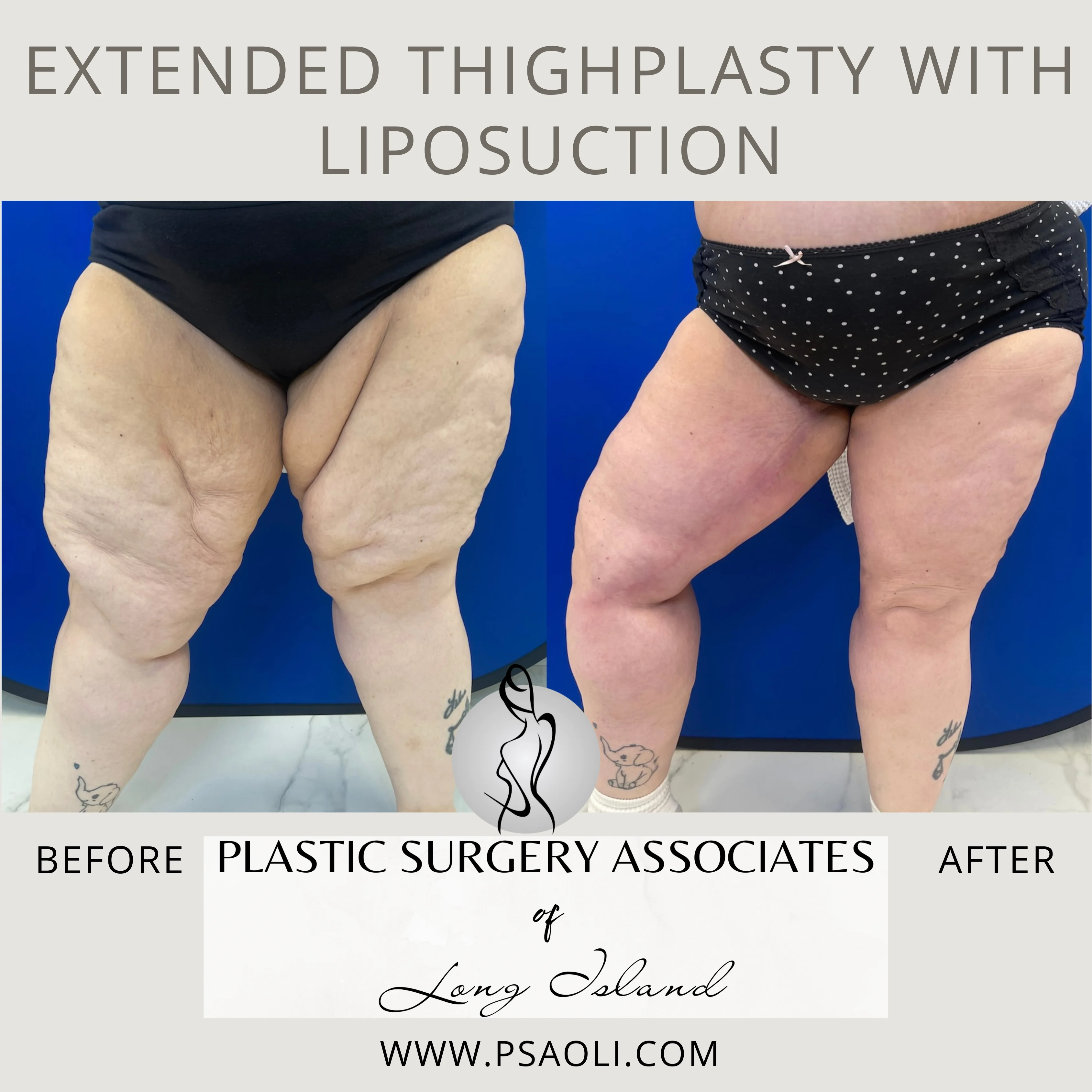 Extended ThighPlasty with Liposuction – 3