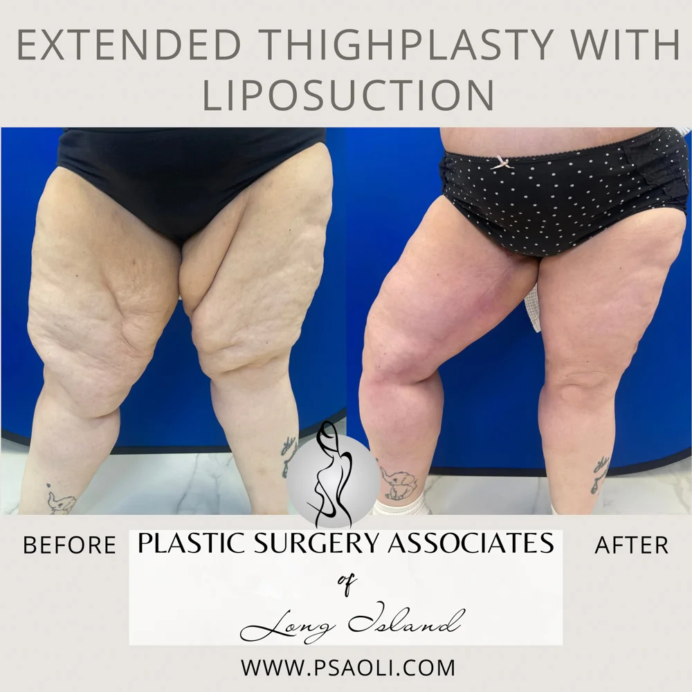 Extended ThighPlasty with Liposuction – 3