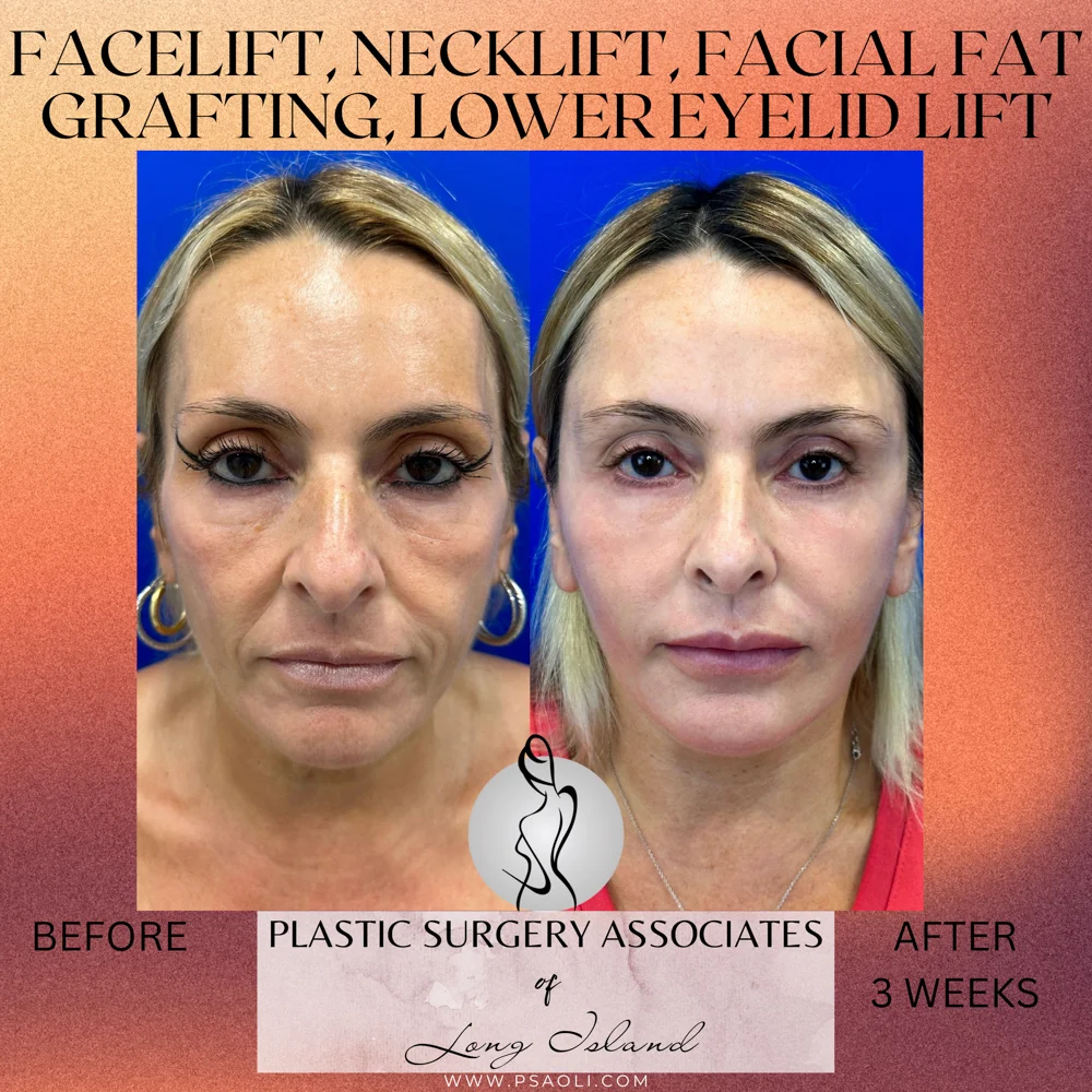 Happy Valentine_s Day Instagram Square Post Template – 1