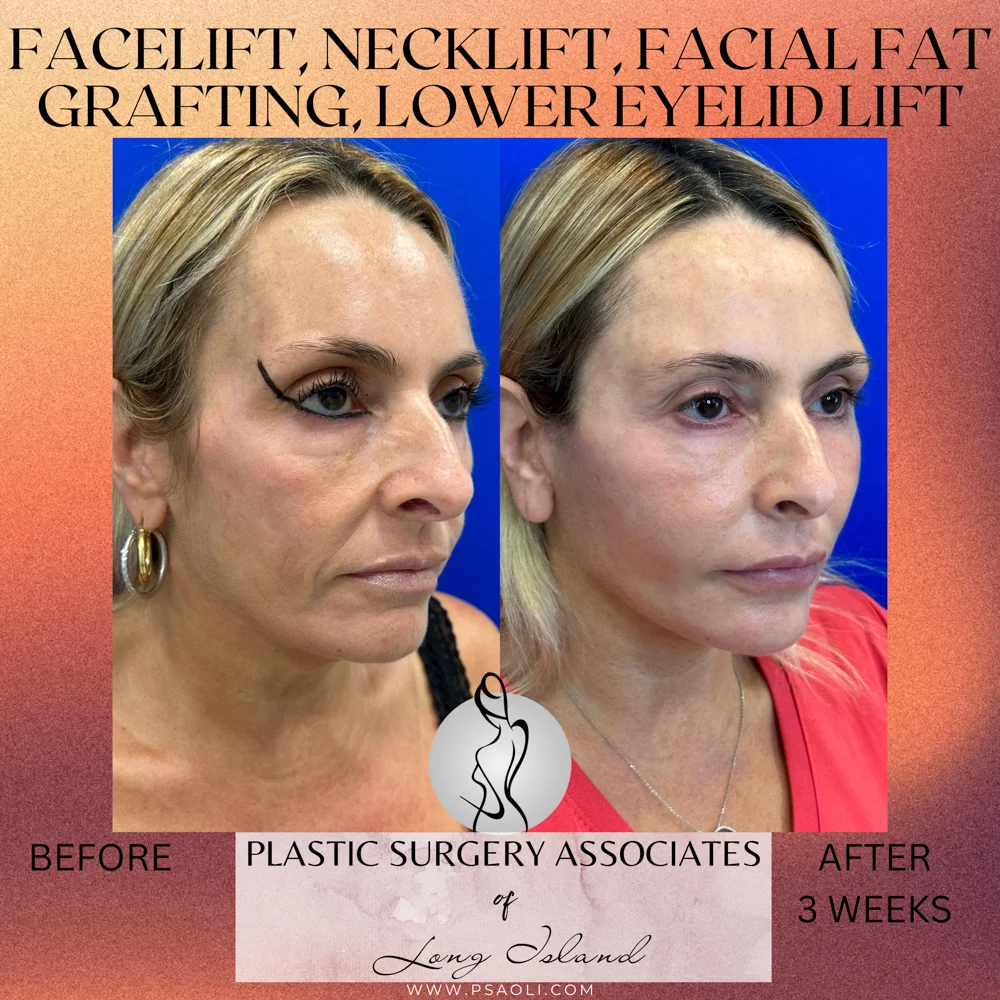 Happy Valentine_s Day Instagram Square Post Template – 2