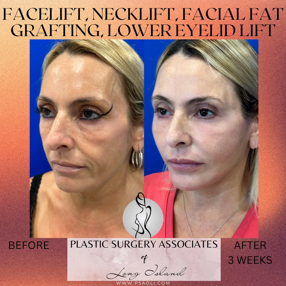 Happy Valentine_s Day Instagram Square Post Template – 3