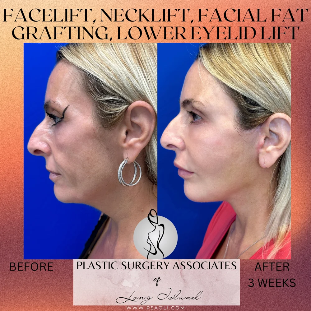 Happy Valentine_s Day Instagram Square Post Template – 4