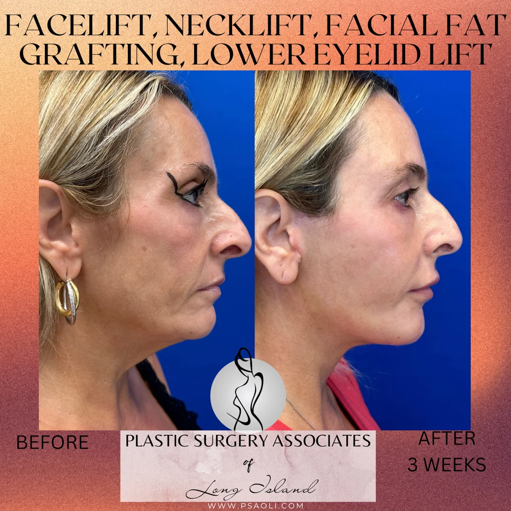 Happy Valentine_s Day Instagram Square Post Template – 5