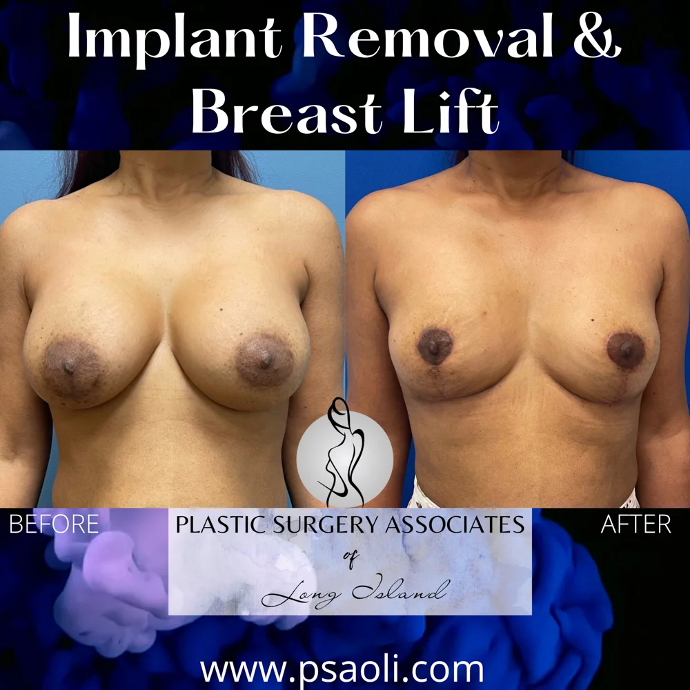 Implant Removal & Breast Lift – 1