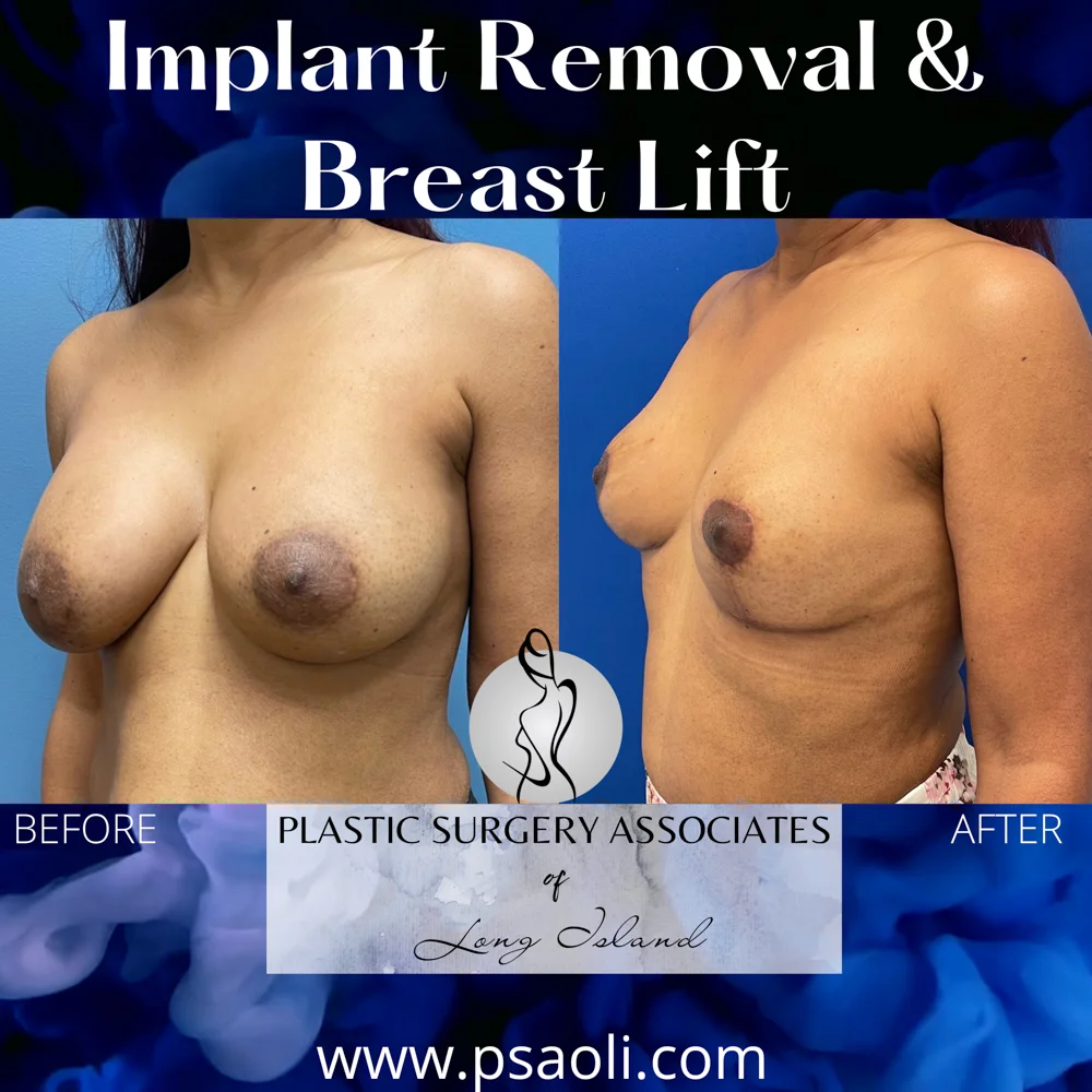 Implant Removal & Breast Lift – 2
