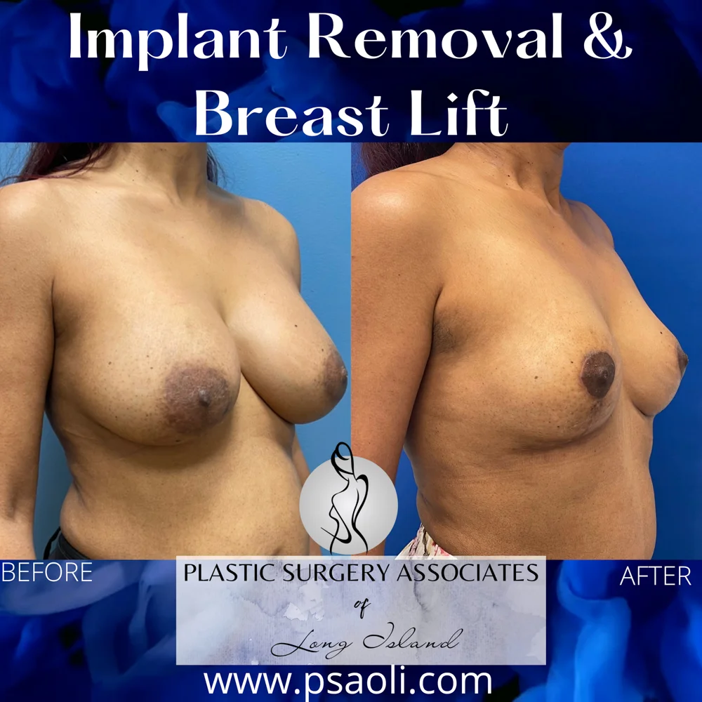 Implant Removal & Breast Lift – 3