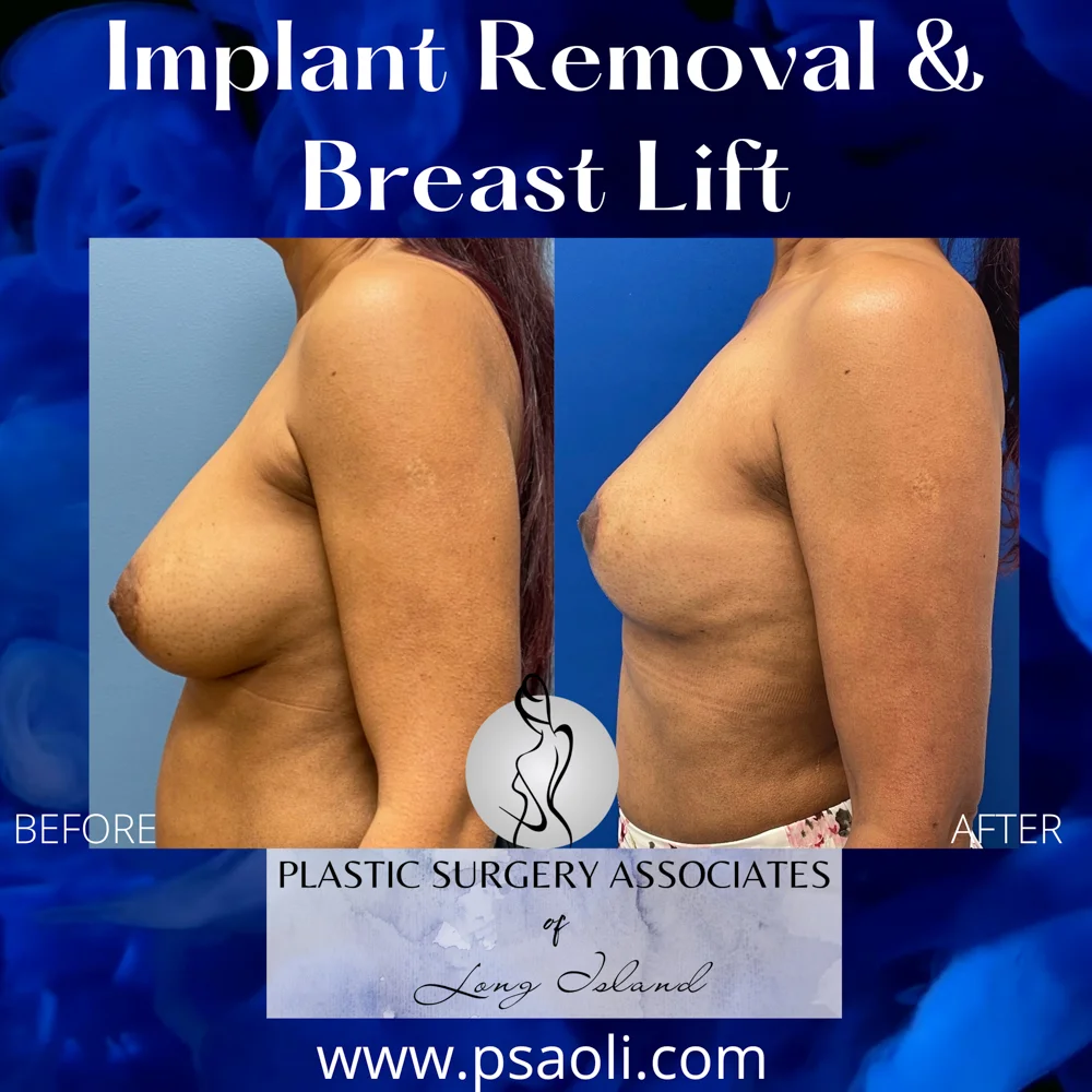 Implant Removal & Breast Lift – 4