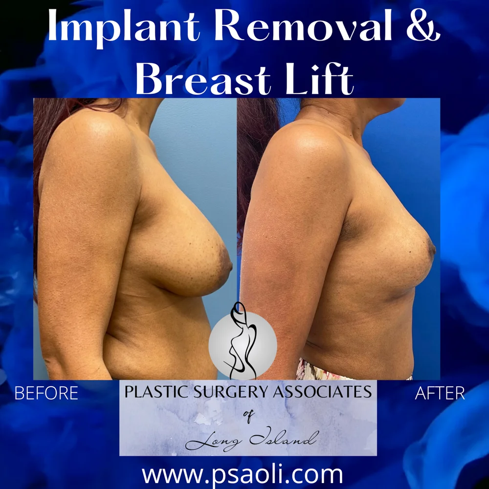 Implant Removal & Breast Lift – 5