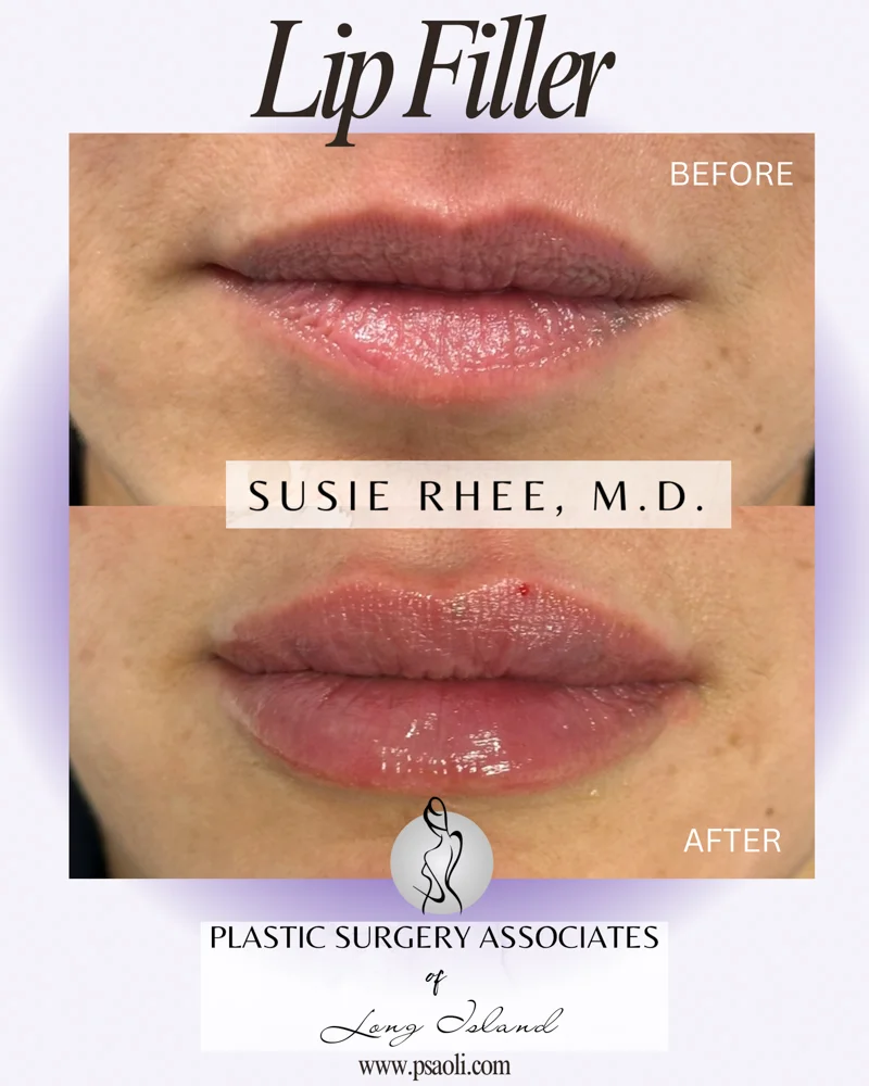Lip Filler 1 – 1