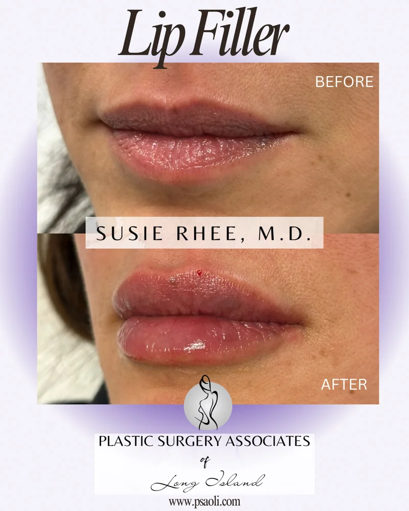 Lip Filler 1 – 2