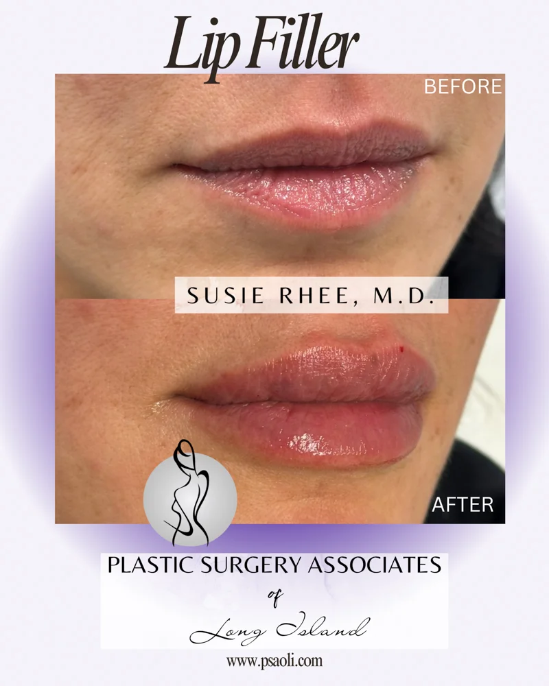 Lip Filler 1 – 3