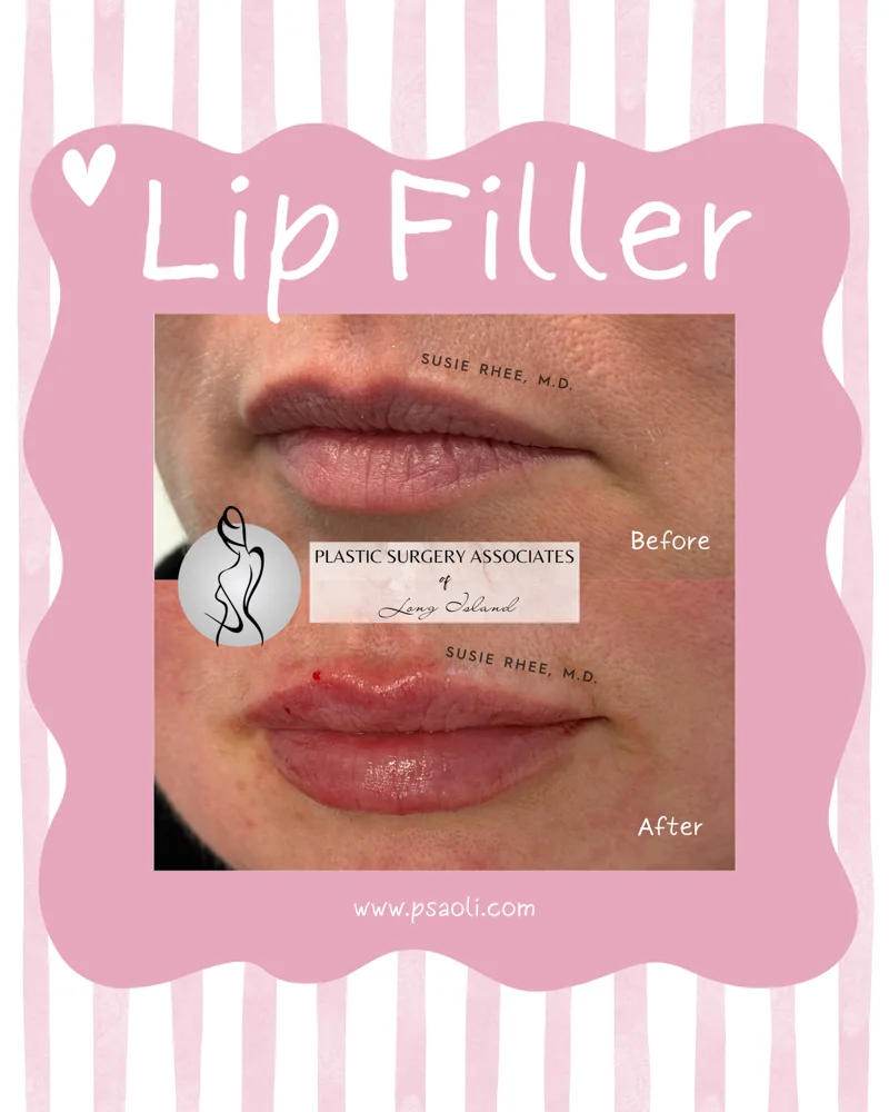 Lip Filler – 1