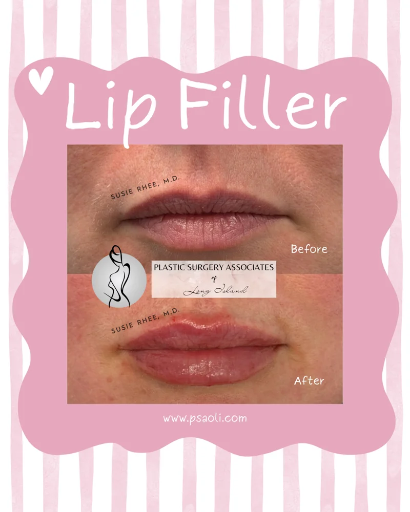 Lip Filler – 2