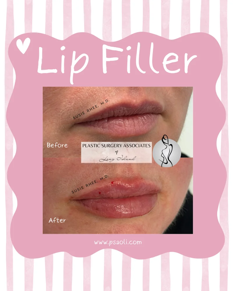 Lip Filler – 3 (1)