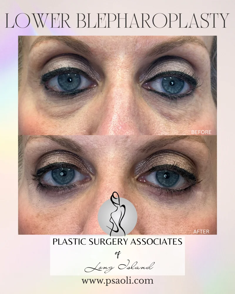 Lower blepharoplasty – 1