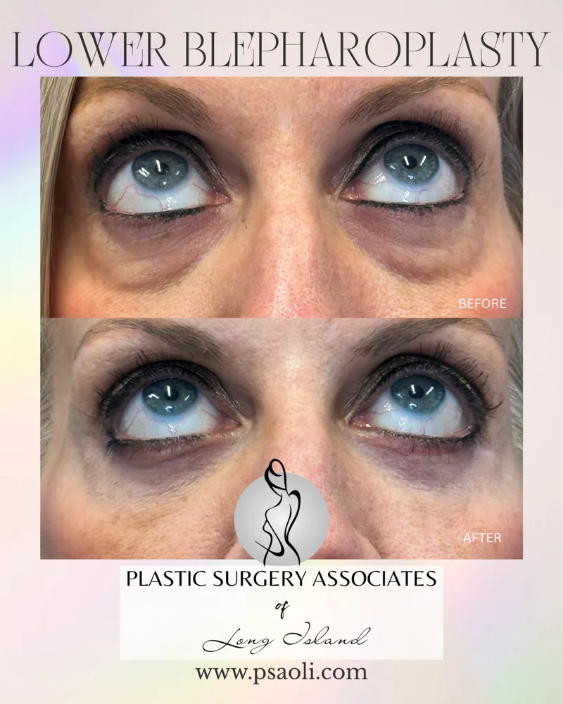Lower blepharoplasty – 2