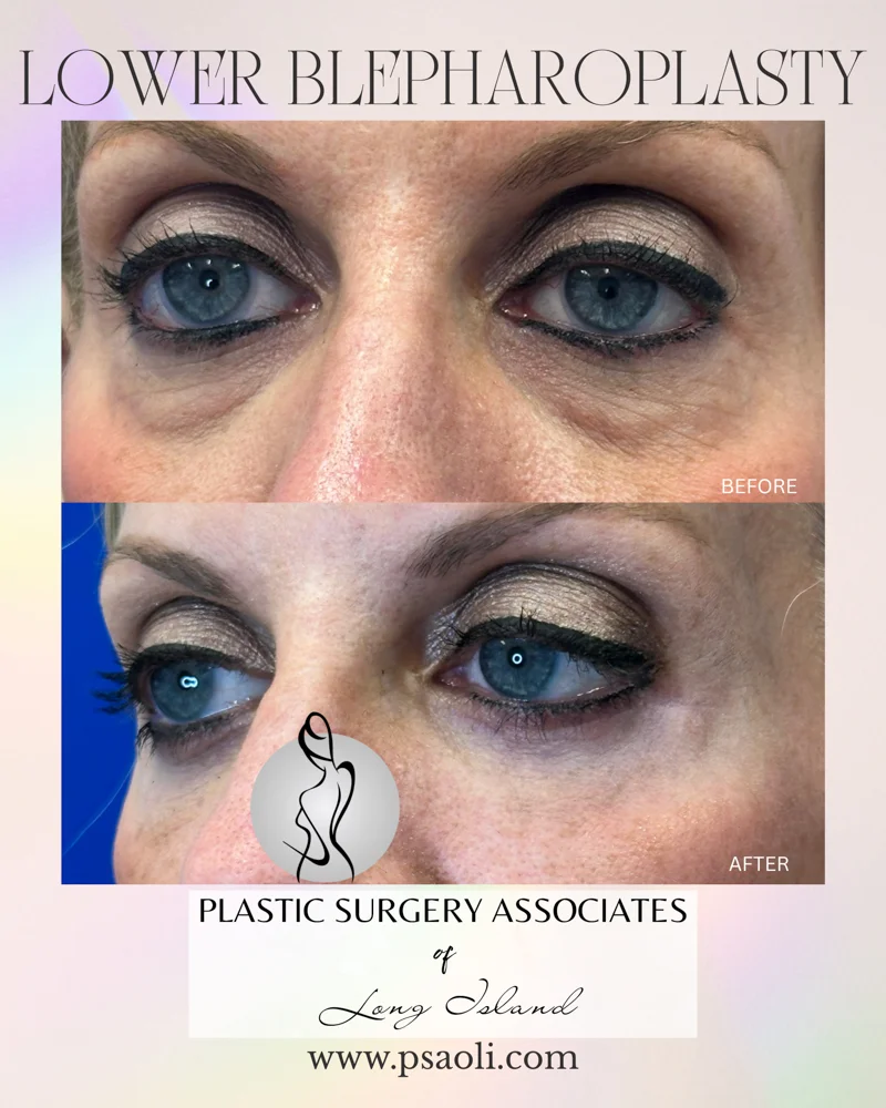 Lower blepharoplasty – 3