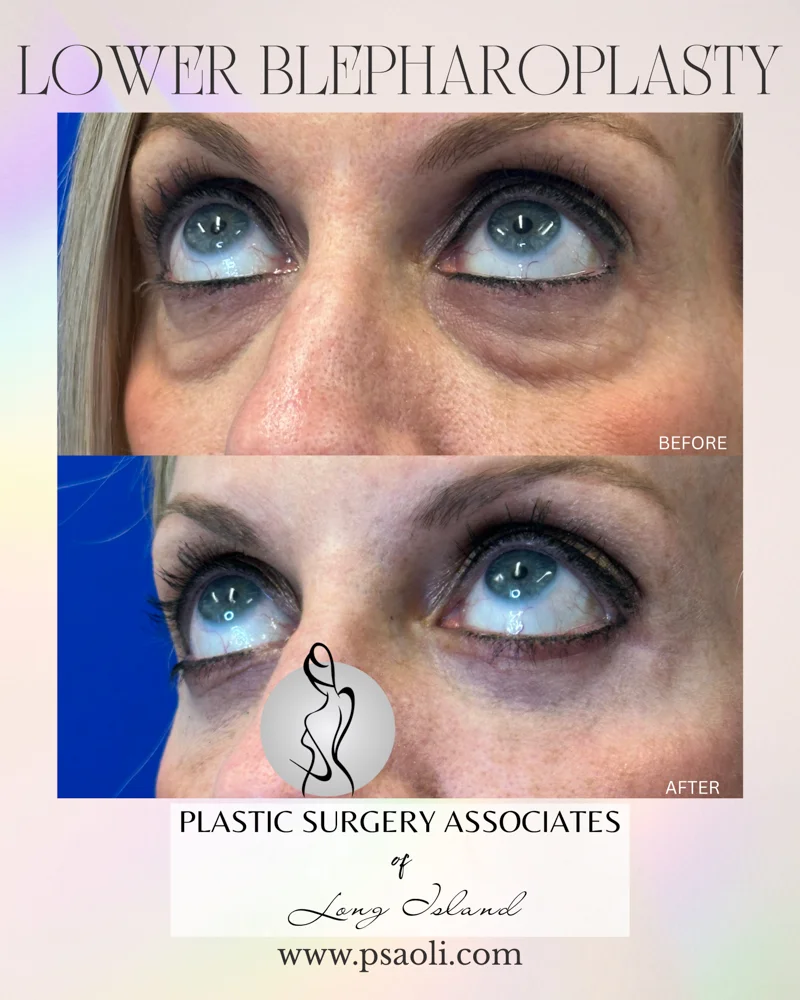 Lower blepharoplasty – 4