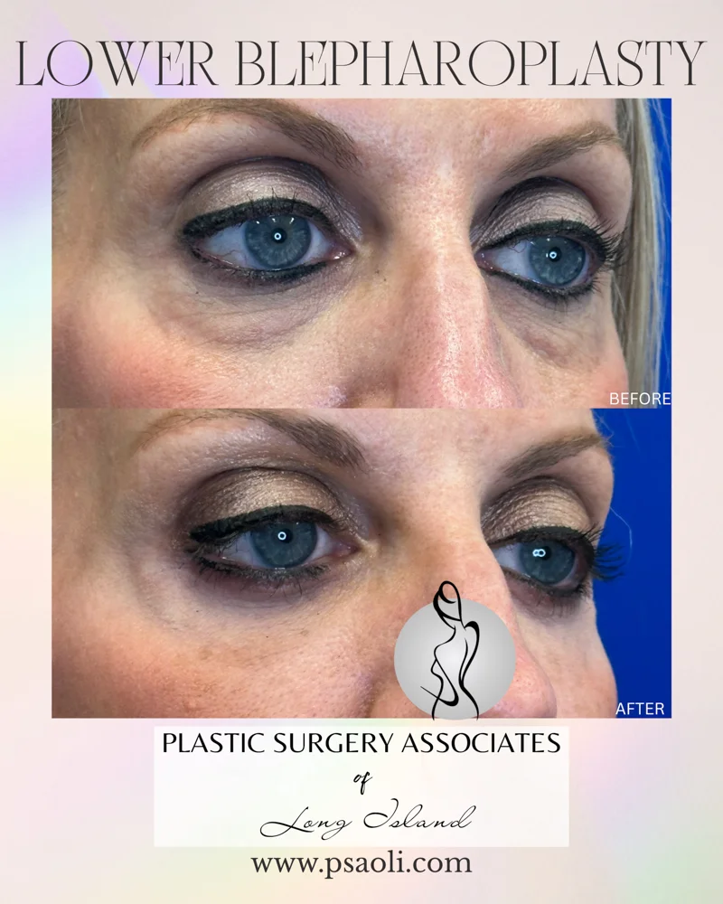 Lower blepharoplasty – 5