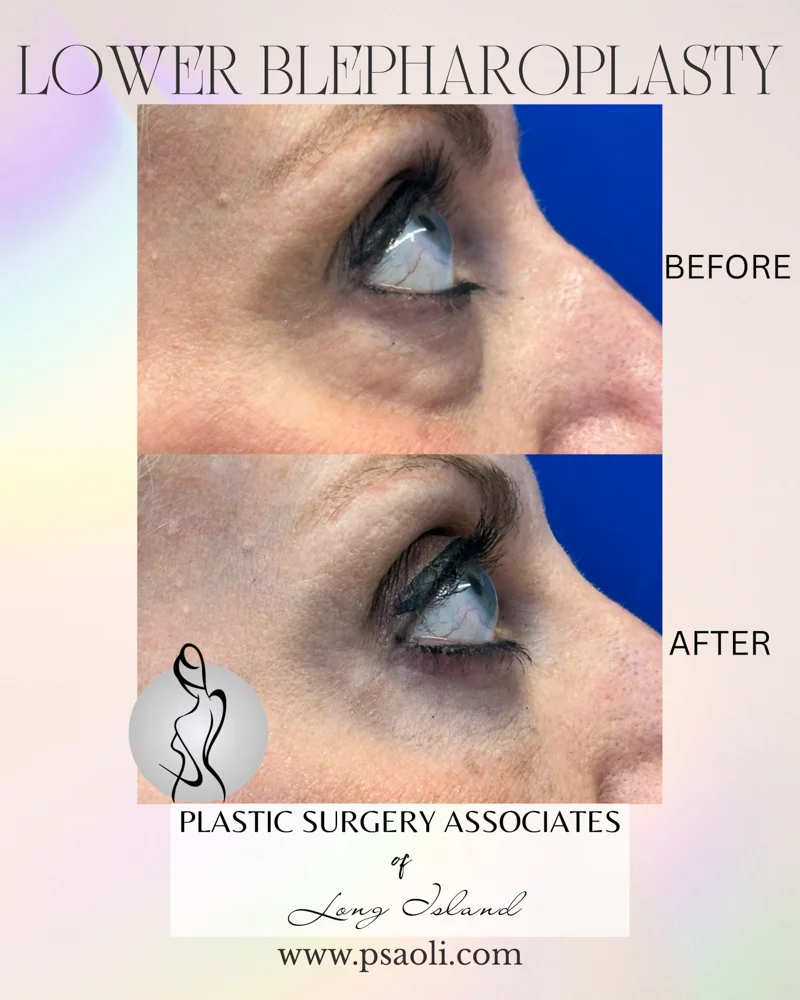 Lower blepharoplasty – 7