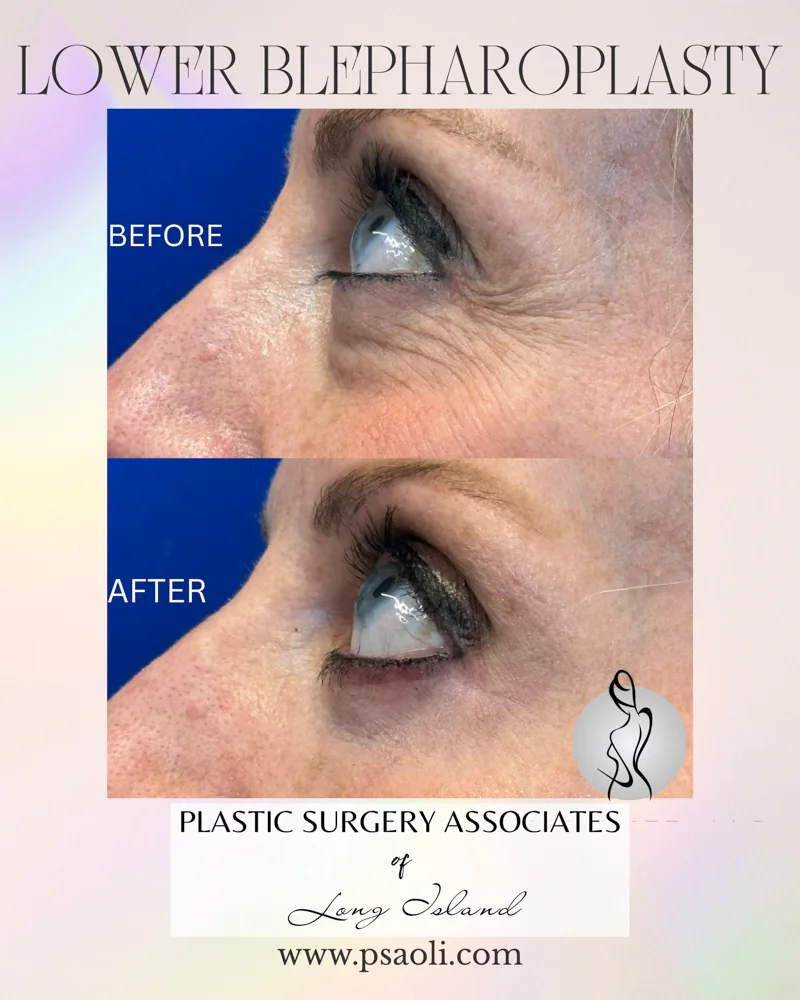 Lower blepharoplasty – 8