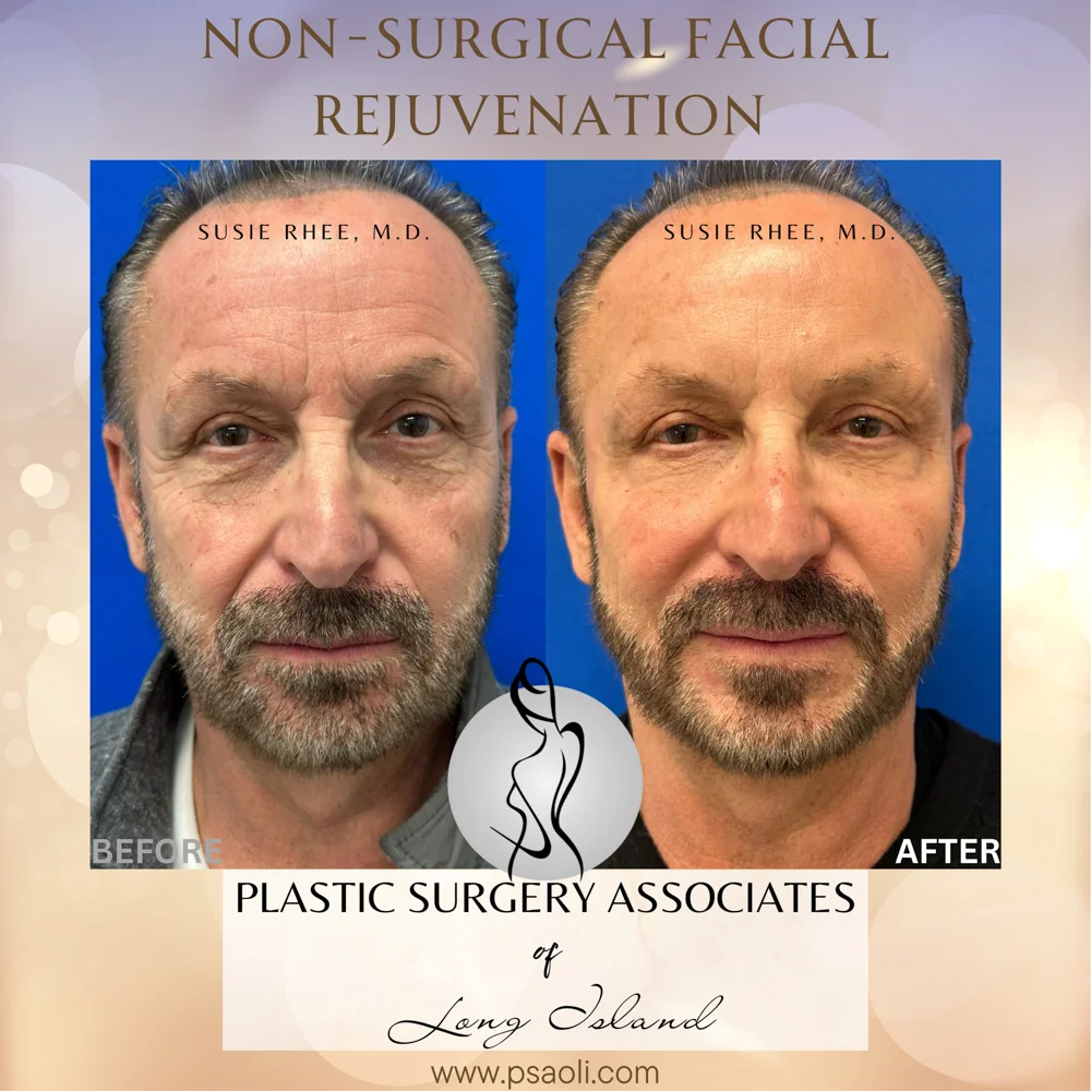 Non-Surgical Facial Rejuvenation – 1