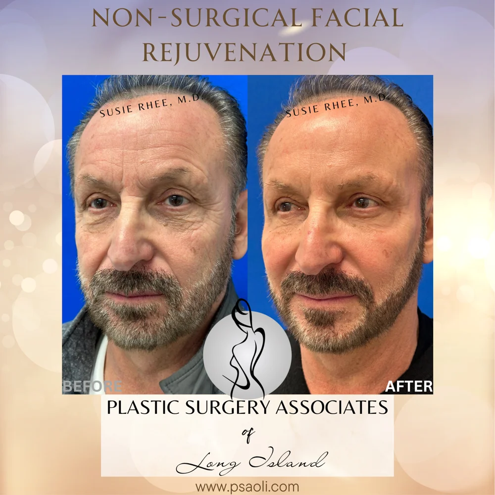 Non-Surgical Facial Rejuvenation – 2