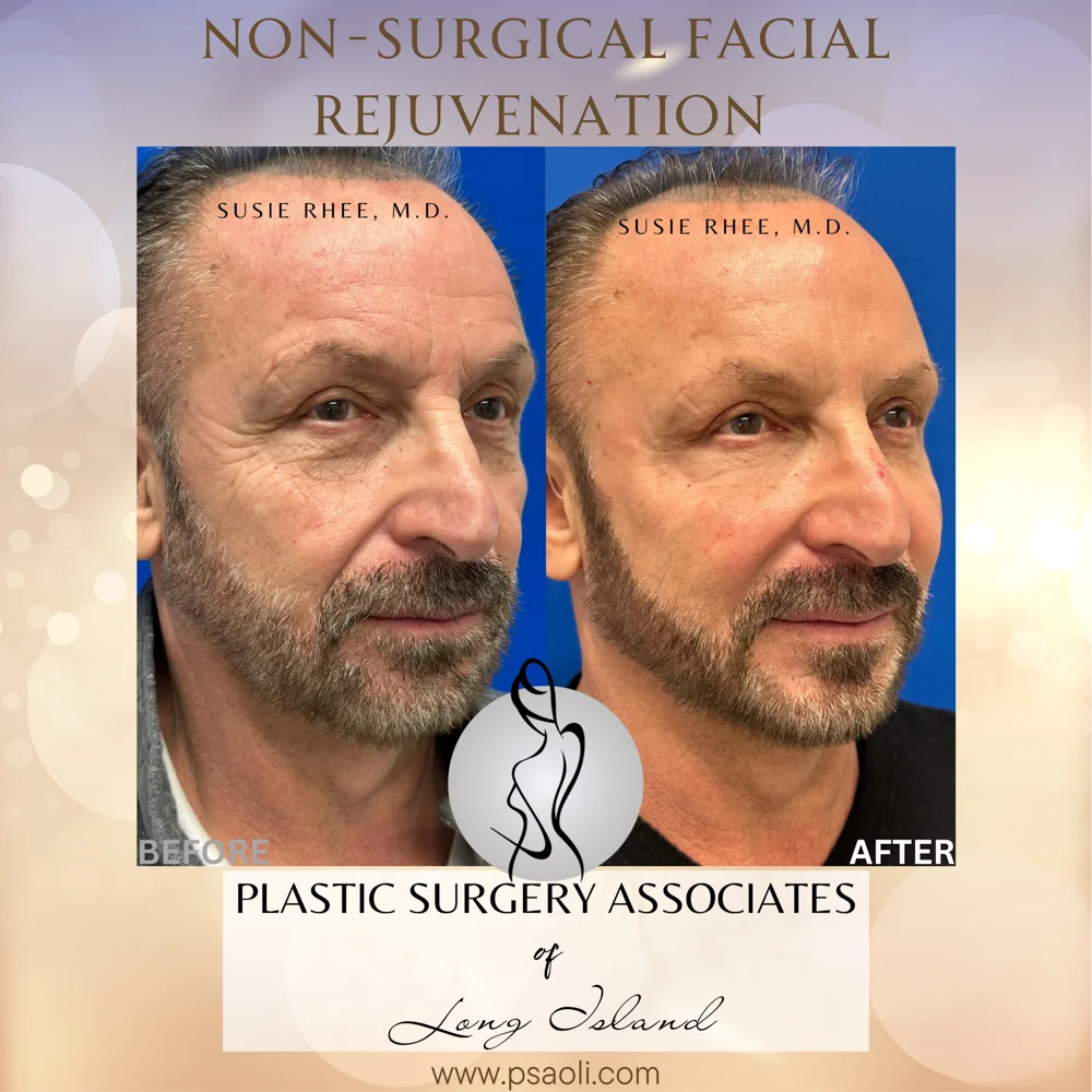 Non-Surgical Facial Rejuvenation – 3