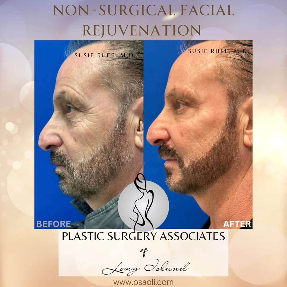Non-Surgical Facial Rejuvenation – 4