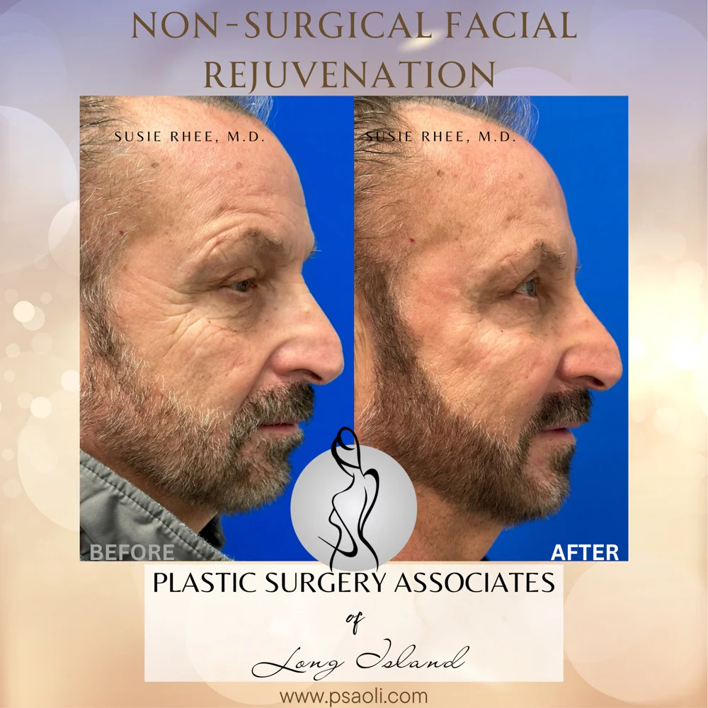 Non-Surgical Facial Rejuvenation – 5