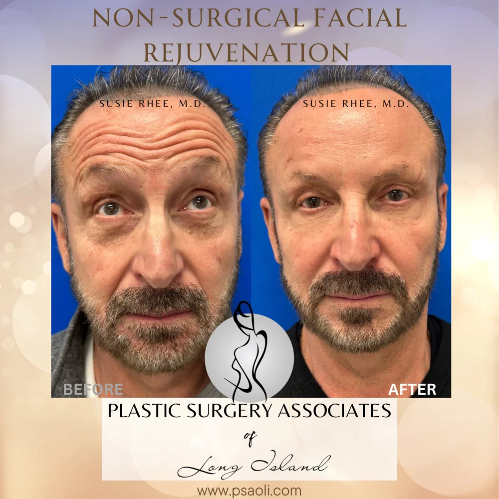 Non-Surgical Facial Rejuvenation – 6