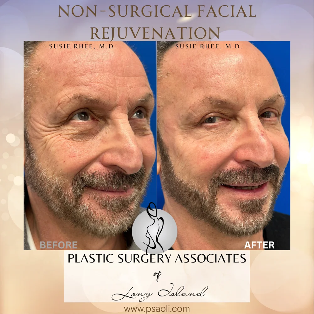 Non-Surgical Facial Rejuvenation – 7