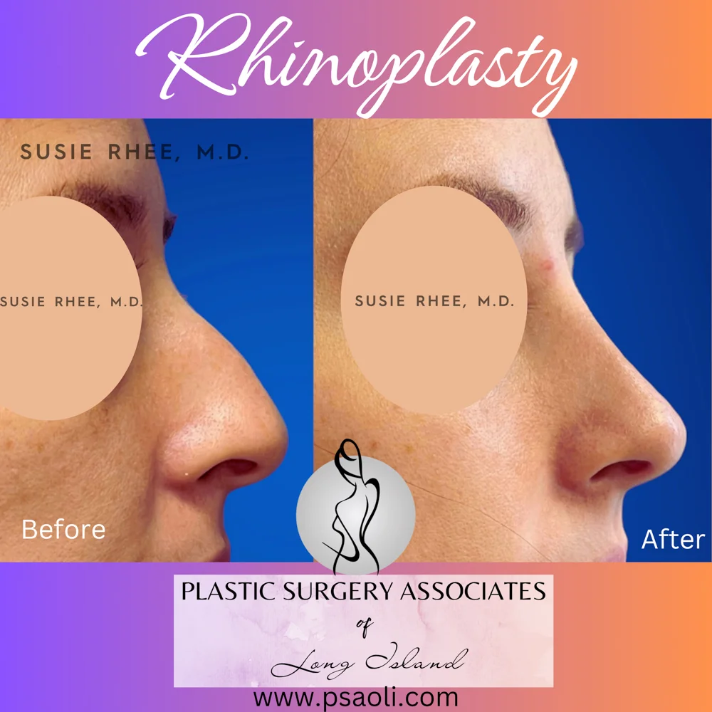 Rhinoplasty – 1