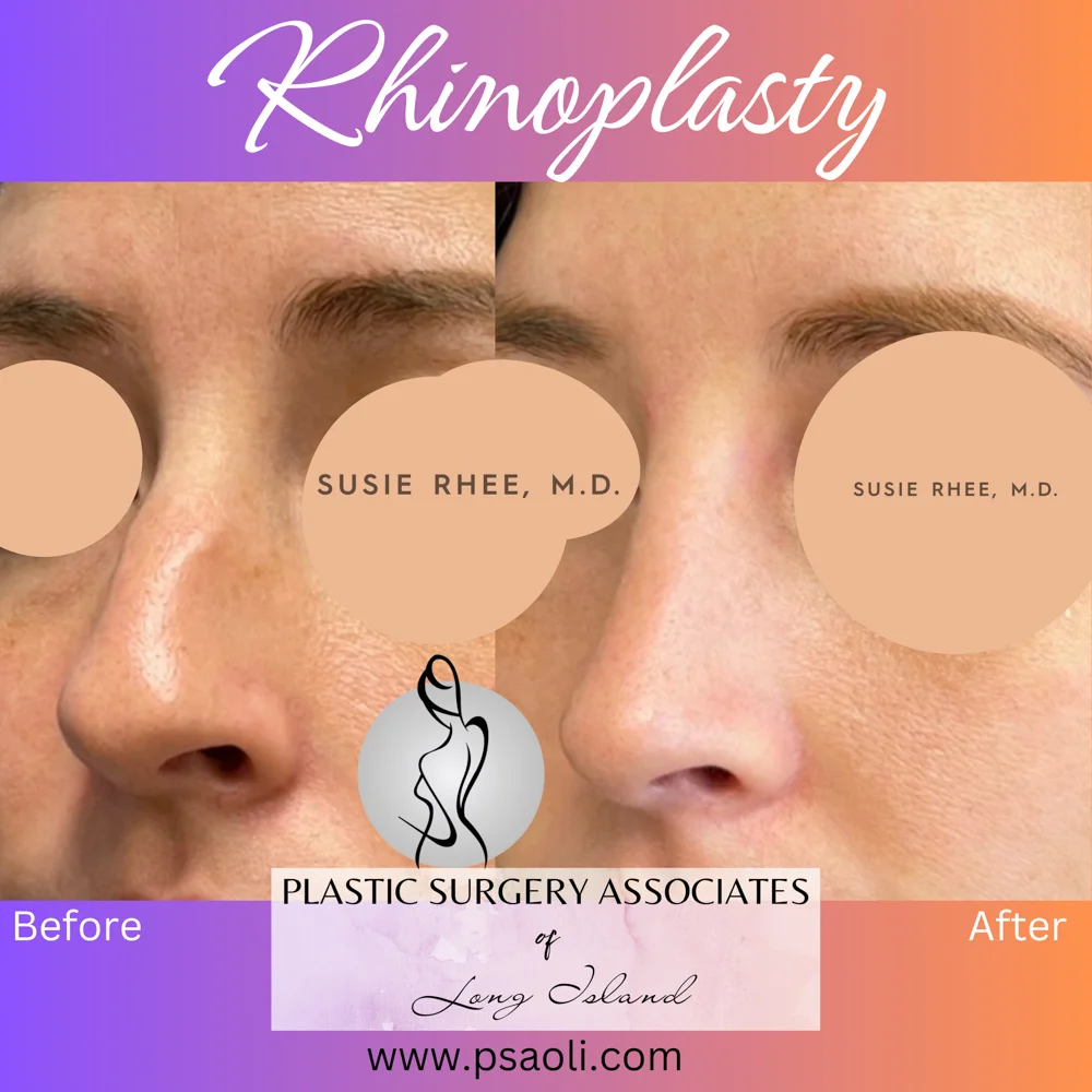 Rhinoplasty – 2