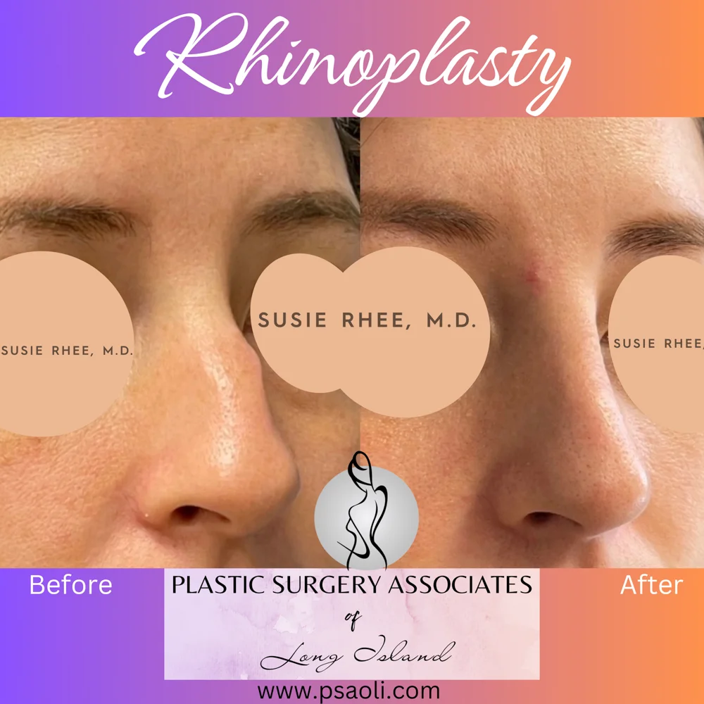 Rhinoplasty – 3