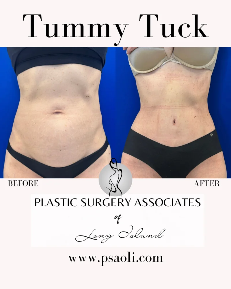 Tummy Tuck – 1