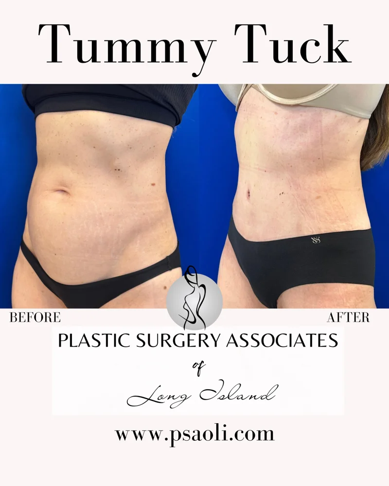 Tummy Tuck – 2